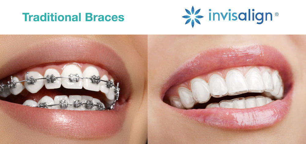traditional vs invisalign braces